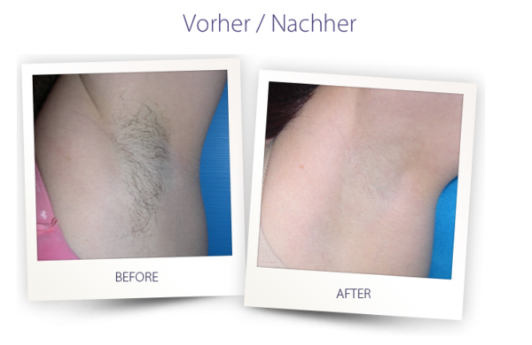 Dermateam Winterthur, Haarentfernung Winterthur Hautarzt Laser Epilation